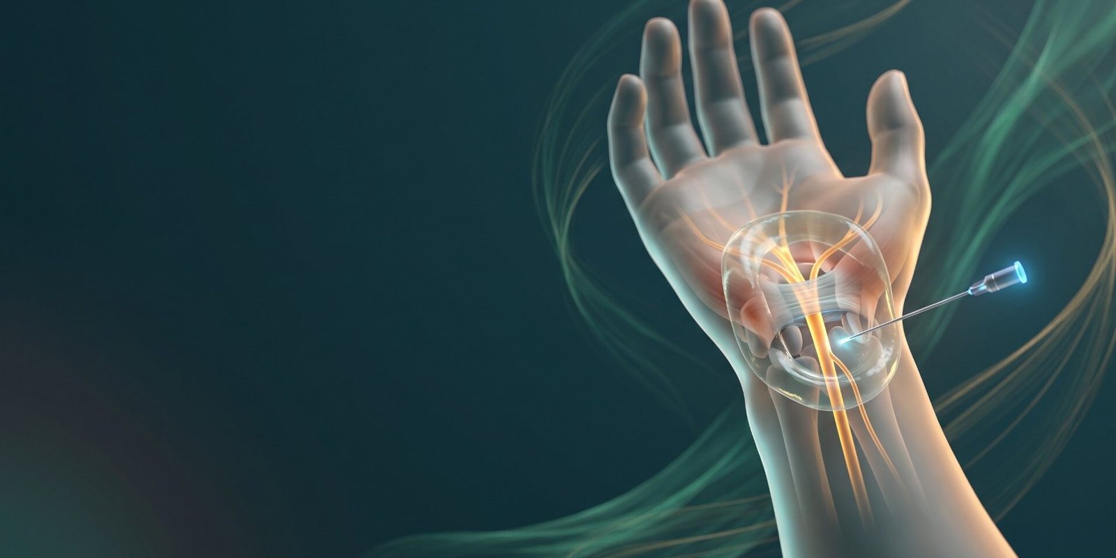 Karpaltunnelsyndrom ohne OP: Handgelenk mit Mittelnerv und Injektion unter Ultraschall